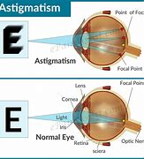 Image result for Astigmatism Eye