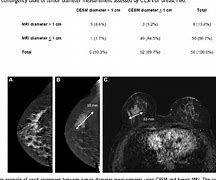 Image result for Tumor Size Measurement