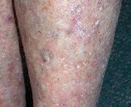 Image result for Actinic Keratosis Legs