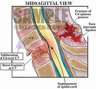 Image result for C7 Fracture Symptoms