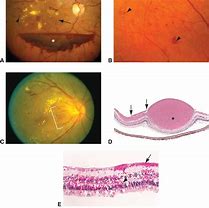Image result for Causes of Retinal Hemorrhage