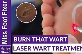 Image result for Wart Laser Treatment