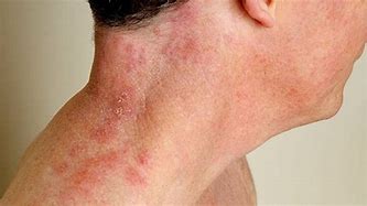 Image result for Pictures of Shingles Rash