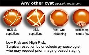 Image result for How Big Is 4 Centimeter Cyst