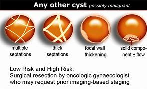 Image result for How Big Is 4 Cm Cyst