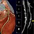 Image result for CT Coronary Angiogram