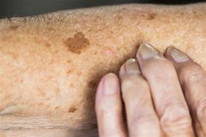 Image result for Liver Spots On Feet