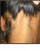 Image result for Alopecia Areata Ophiasis