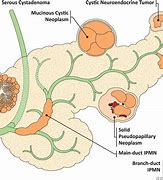 Image result for Benign Tumor On Pancreas