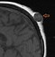 Image result for Sebaceous Cyst Scalp CT