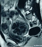Image result for IRM Chist Dermoid Ovarian