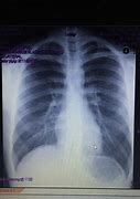 Image result for co_to_znaczy_zapalenie_płuc