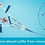 Image result for PICC Valve