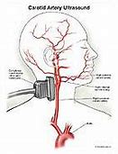 Image result for Carotid Web