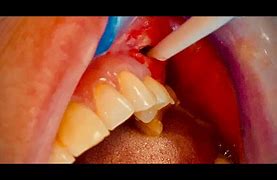 Image result for Radicular Cyst vs Periapical Abscess