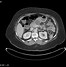 Image result for Pancreas MRI