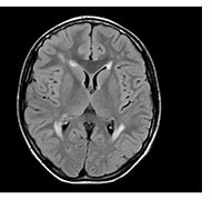 Image result for Supratentorial White Matter