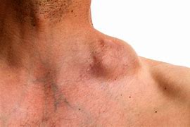 Image result for Lymphoma Swollen Lymph Nodes in Neck