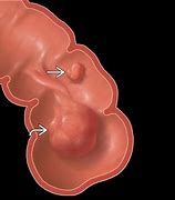 Image result for Sessile Polyp in Sigmoid Colon