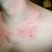 Image result for Allergic Rash On Neck