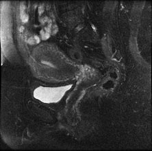 Image result for Complications of Ovarian Dermoid