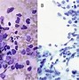 Image result for Round Cell Sarcoma