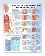 Image result for Sexually Transmitted Infections Chart