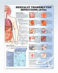 Image result for Sexually Transmitted Diseases Poster