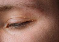 Image result for Flat Warts On Eyelids