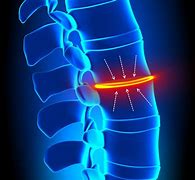 Image result for discal