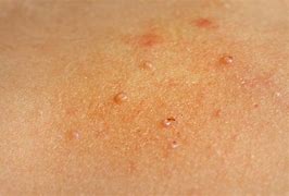 Image result for Inflamed Molluscum Contagiosum