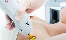 candela laser laser hair removal small area mayical skincare candela laser laser hair removal small area mayical skincare