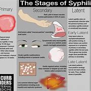 Image result for Syphilis