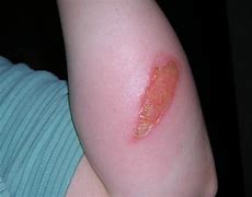 Image result for 2nd Degree Burn Scar