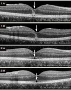 Image result for Solar Maculopathy Oct