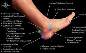 Image result for Foot Pain Chart
