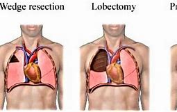 Image result for Lung Cancer Operation