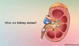 Image result for Nodule On Kidney