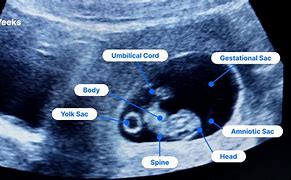 Image result for Normal Pregnancy Ultrasound