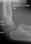 Image result for Lateral View of Elbow X-ray Labeled