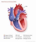 Image result for PDA Disease