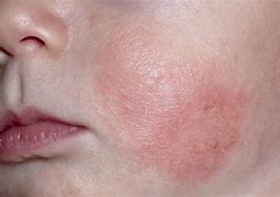 Image result for Eczema Treatment in a 5 Month Old Baby