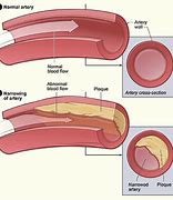 Image result for Severe Atherosclerosis