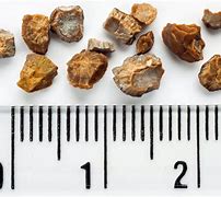 Image result for Big Kidney Stones