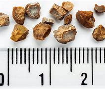 Image result for 1 Cm Kidney Stone