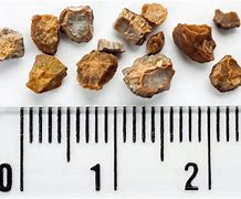 Image result for 3Mm Kidney Stone