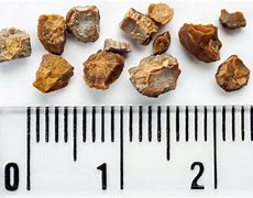 Image result for 6Mm Stone in Kidney