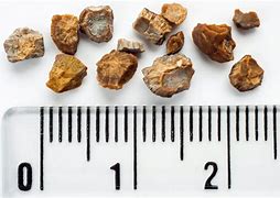 Image result for 3Mm Kidney Stone Actual Size