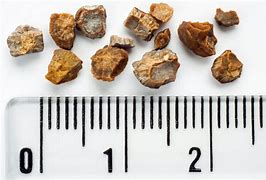 Image result for 12 mm Kidney Stone