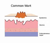 Image result for Anatomy of a Wart